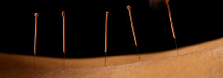 Chiropractic Frederick MD Dry Needling On Back